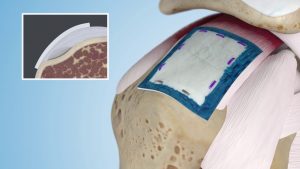 Regeneten Bioinductive