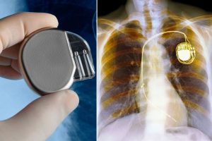 Batteryless Pacemaker