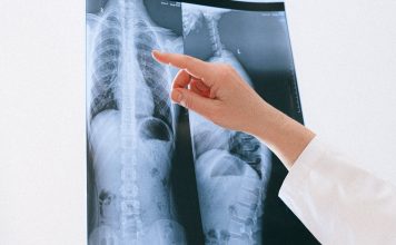 Revolutionizing Lung Nodule Detection with Artificial Intelligence and VisiRad XR