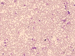 Myelofibrosis