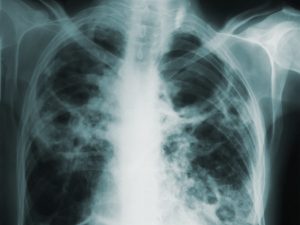 Tuberculosis