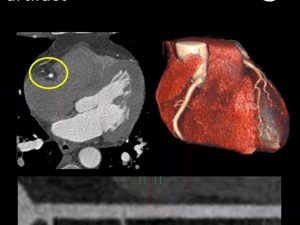Philips Showcases AI Cardiac Solutions