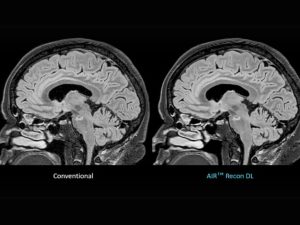 GE HealthCare Expands Deep Learning Imaging Portfoli