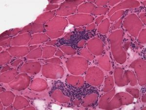 Polymyositis_HE